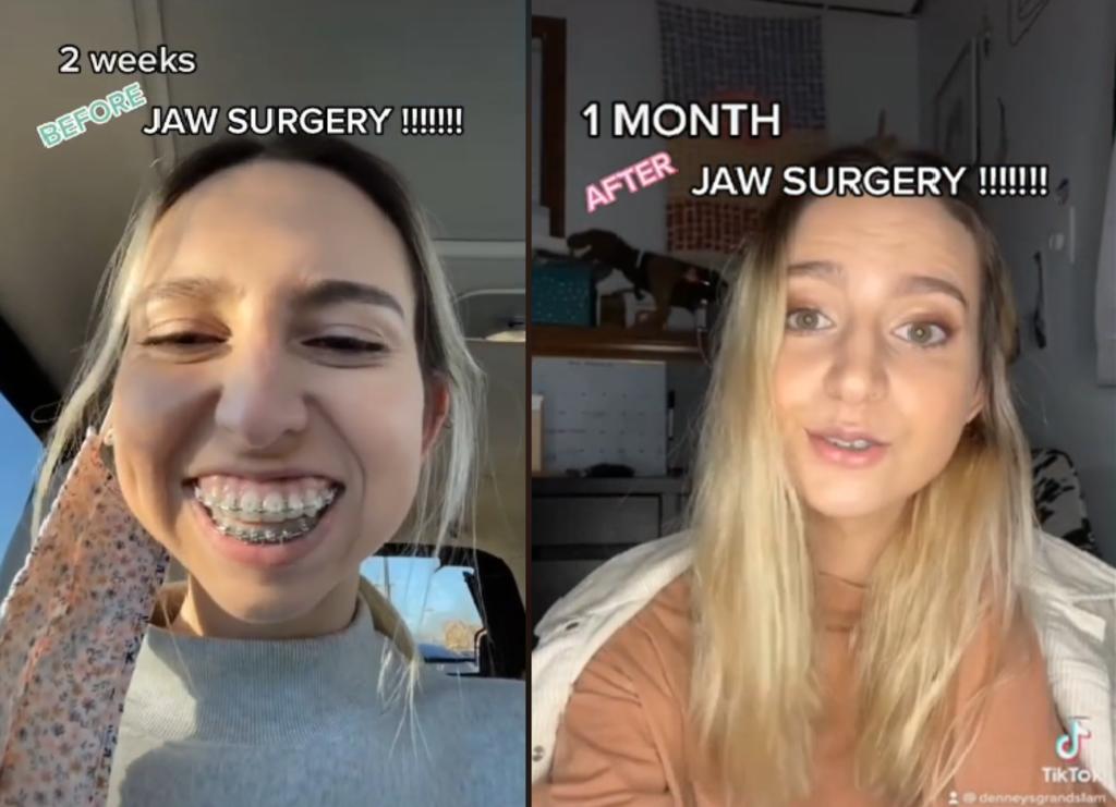 Joven sorprende con su trasformación luego de una cirugía de mandíbula
