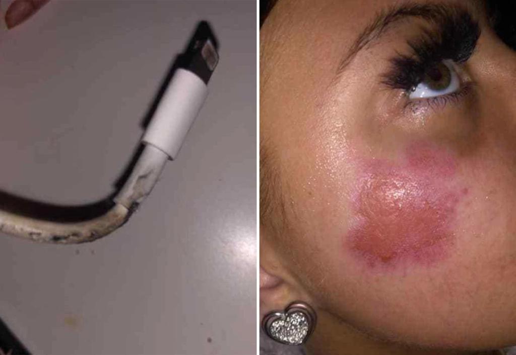Adolescente sufre quemaduras tras que el cargador de su celular estalla
