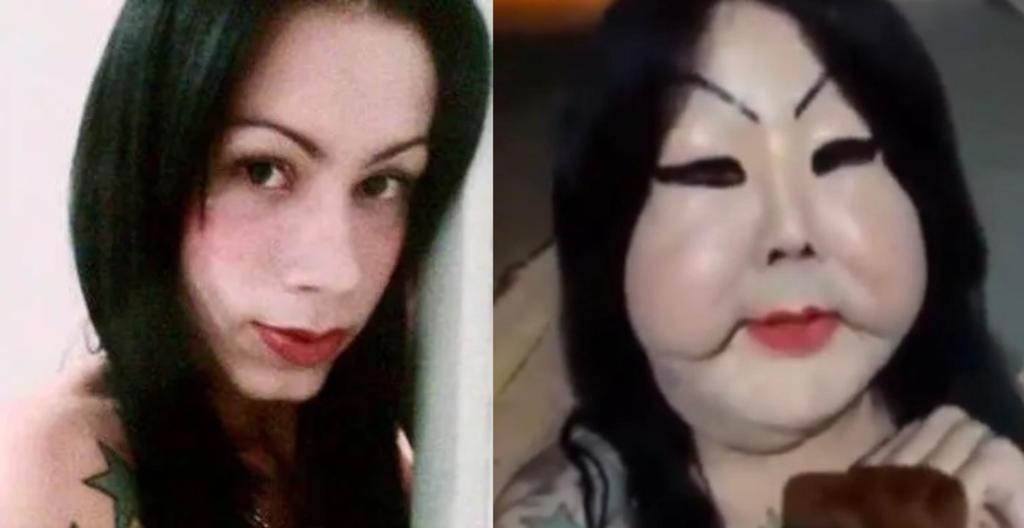 Mujer trans que se inyectó silicona industrial termina con el rostro deformado