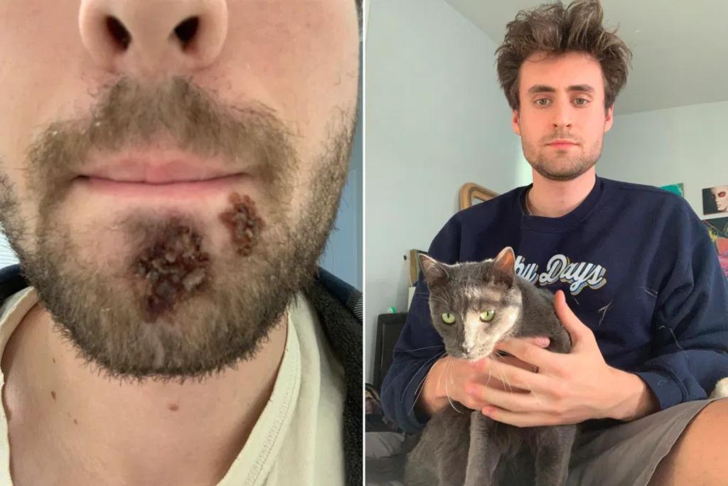 Hombre contrae infección por afeitarse con la rasuradora de otra persona