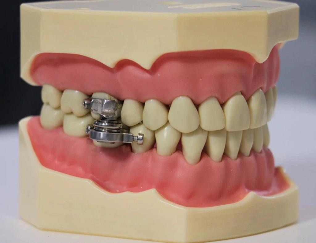 Dispositivo para bajar de peso que ‘cierra los dientes’ genera controversia