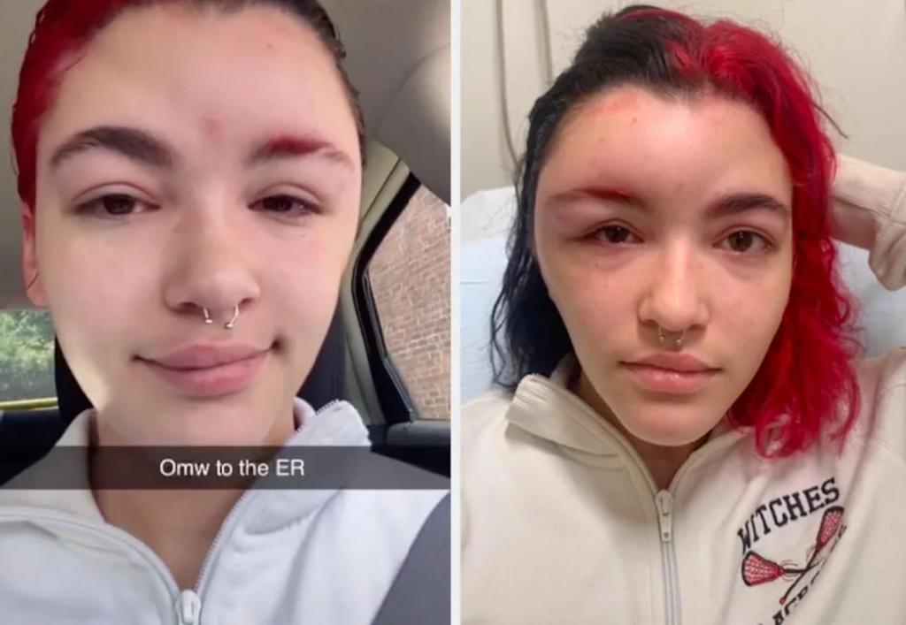 Joven revela que se le hinchó la cabeza por teñirse el cabello