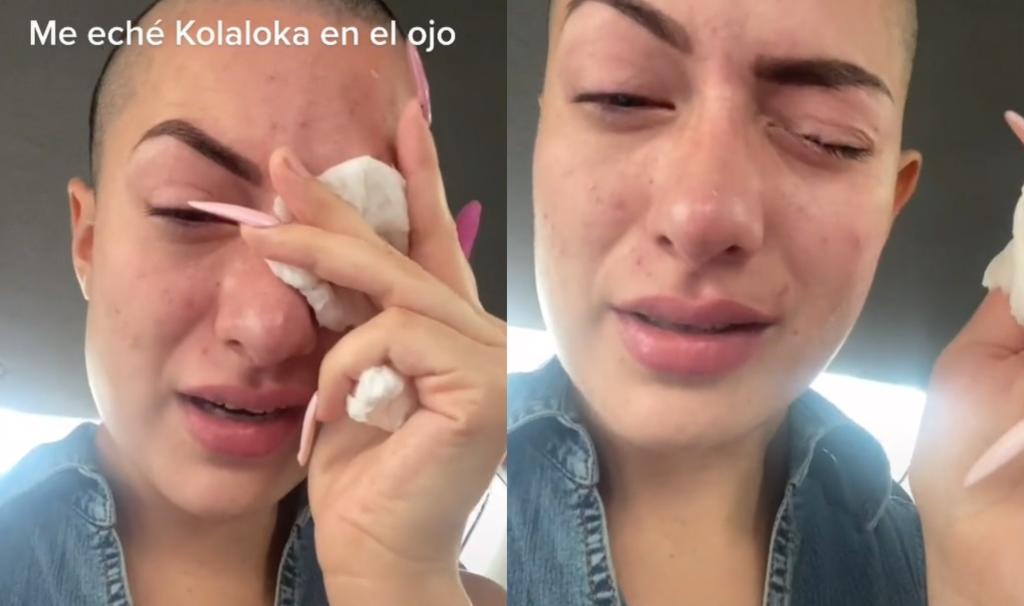 'Tiktoker' termina con el ojo pegado tras 'confundir' pegamento con gotas oculares