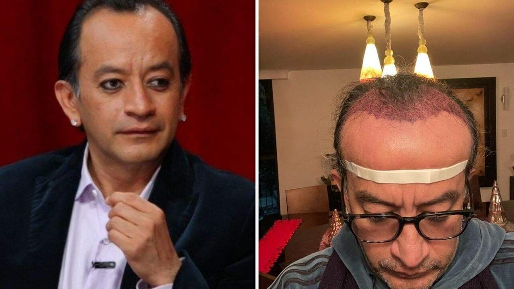 Así fue el proceso de injerto de cabello de Germán Ortega
