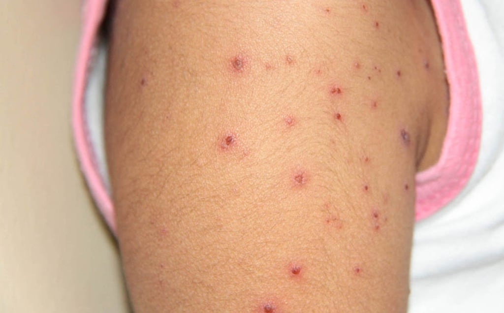 Salud atiende 61 casos de varicela