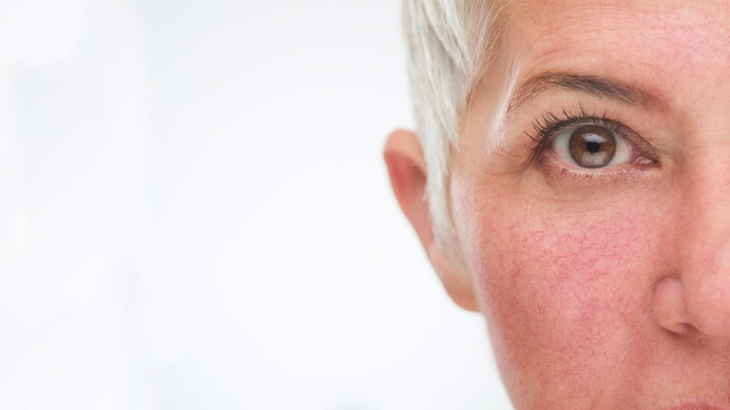 Rosácea: combátela y pon buena cara