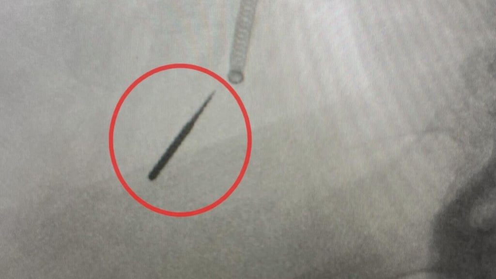 Hombre termina con una pieza de taladro en el pulmón tras visita al dentista