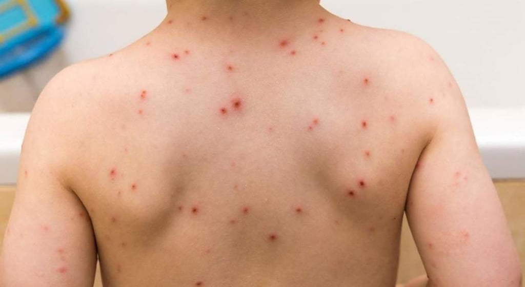 Atienden 144 casos de varicela en Durango