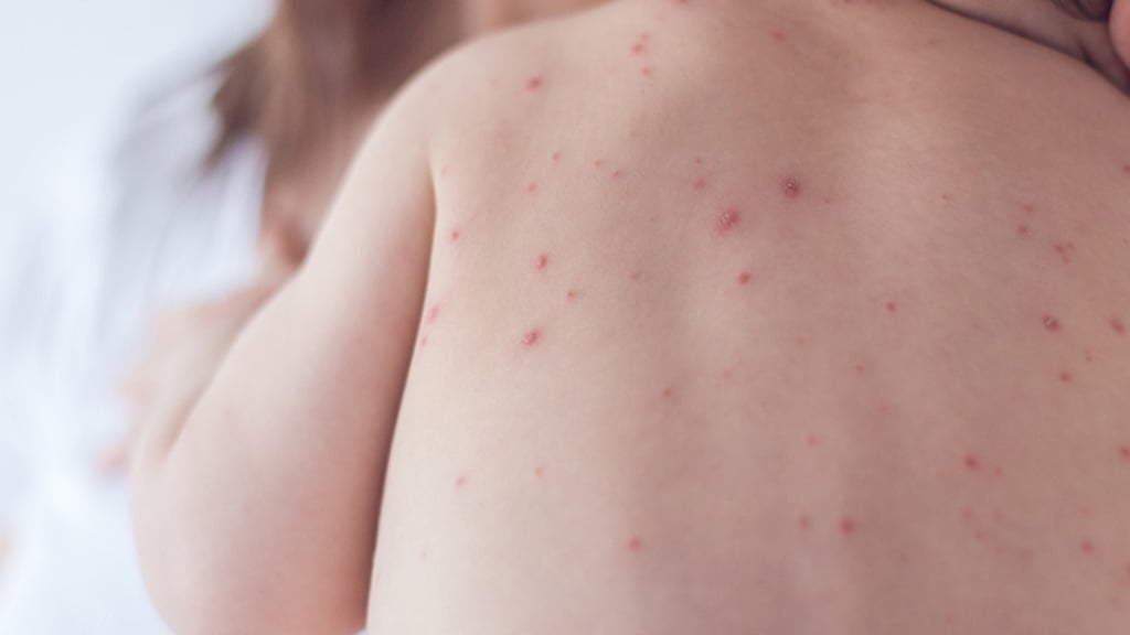 Varicela. Los casos de personas con varicela se han elevado este año, van 314 atendidas.