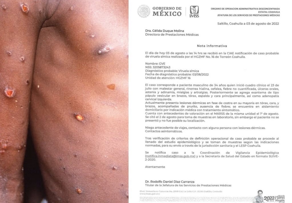 Analizan caso sospechoso de viruela del mono en Torreón
