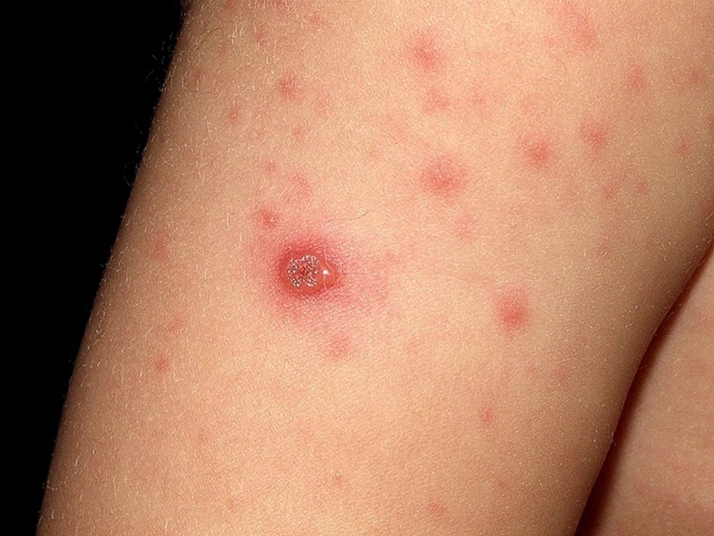 Se han atendido 331 pacientes con varicela