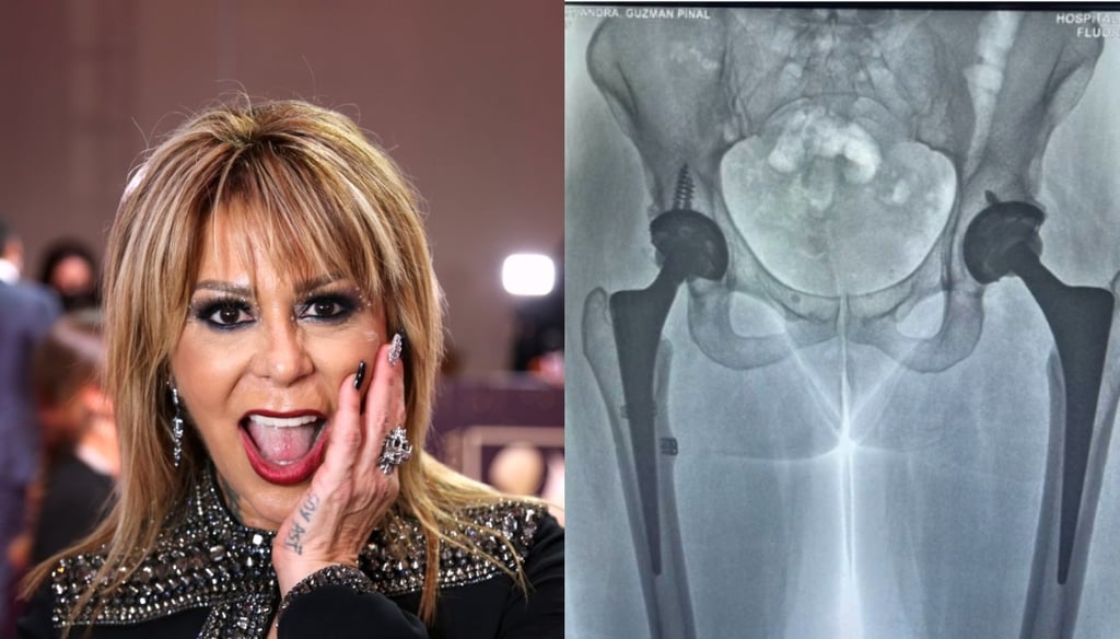 ¿Cómo quedó la cadera de Alejandra Guzmán tras caerse en la mitad de su presentación?