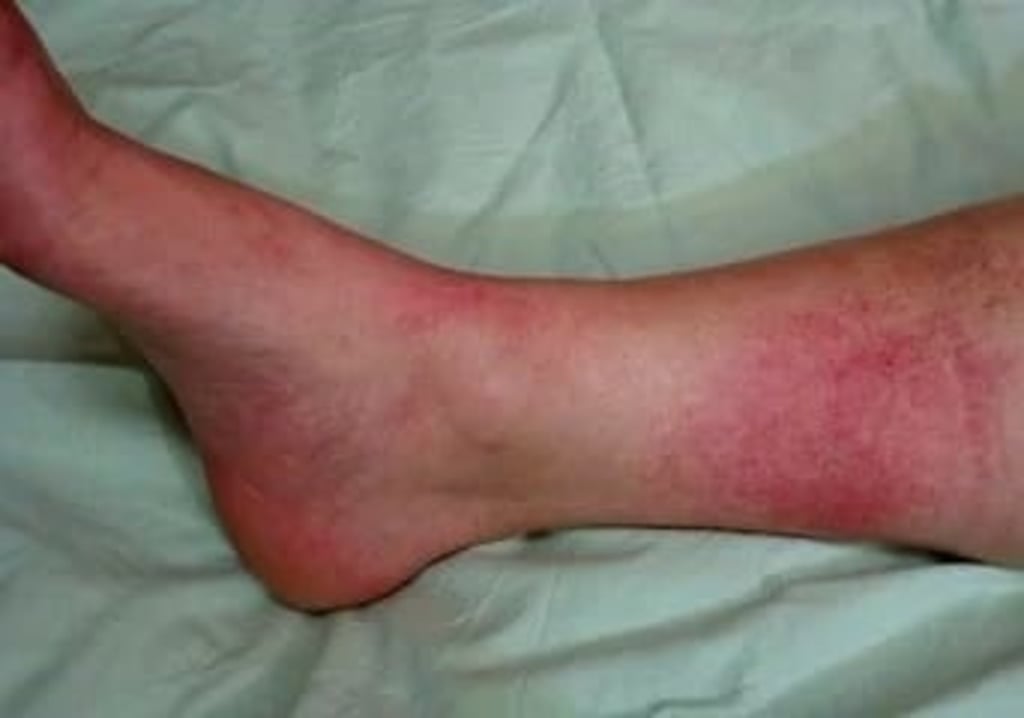 Atendidos, cuatro casos de erisipela