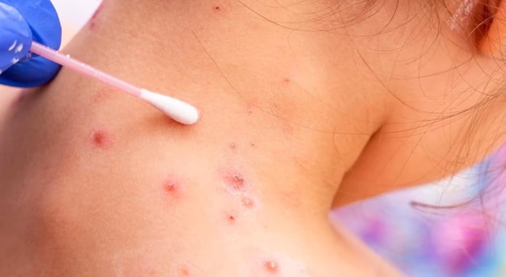 México registra 60 casos de viruela del mono en los últimos 14 días