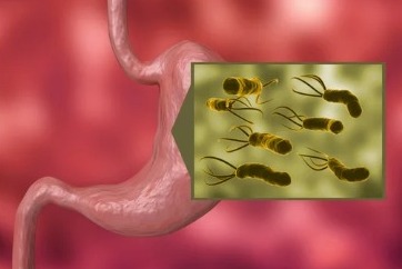 Helicobacter pylori, siete de cada 10 mexicanos están infectados