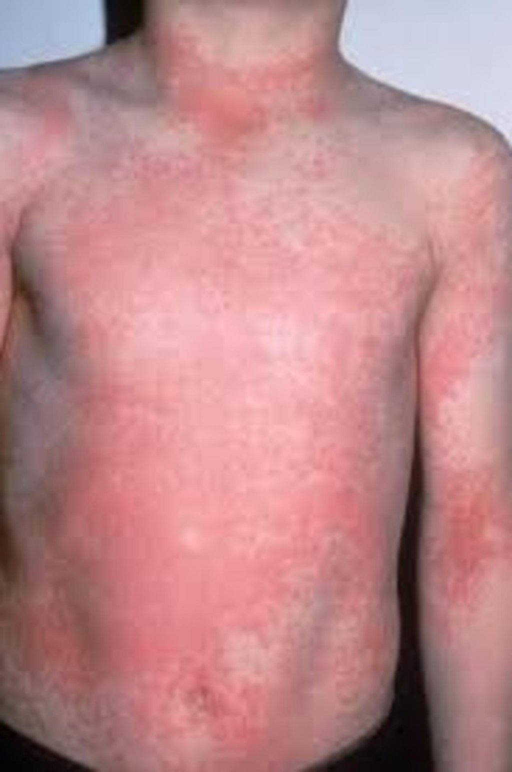 Salud. Este año en Durango han sido atendidos seis pacientes por escarlatina.