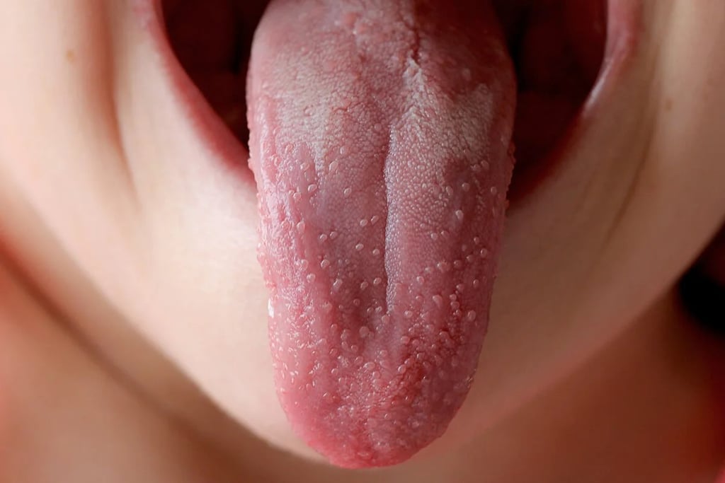 La escarlatina causa fiebre alta, salpullido y puntos en la lengua