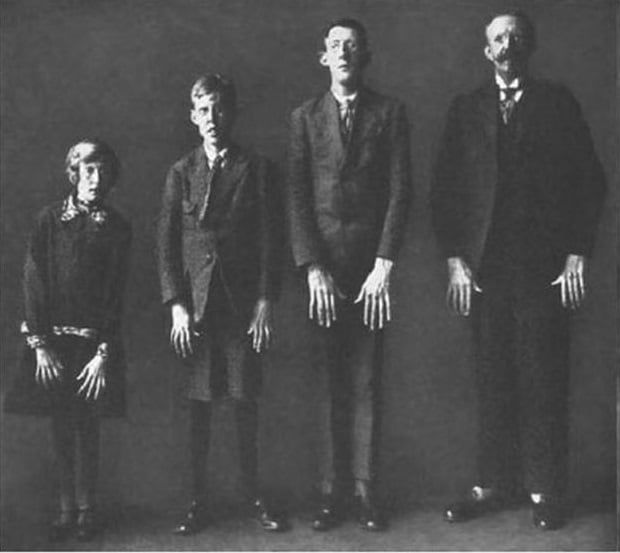 ¿Qué es el síndrome de Marfan y cómo se manifiesta?