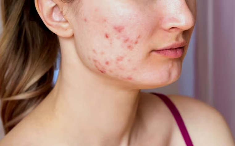 Descubre la mejor vitamina para combatir el acné