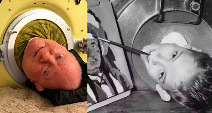 Muere el hombre que vivió 70 años en un 'pulmón de acero'