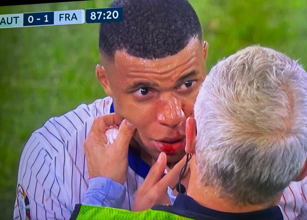 Mbappé, con posible fractura de nariz