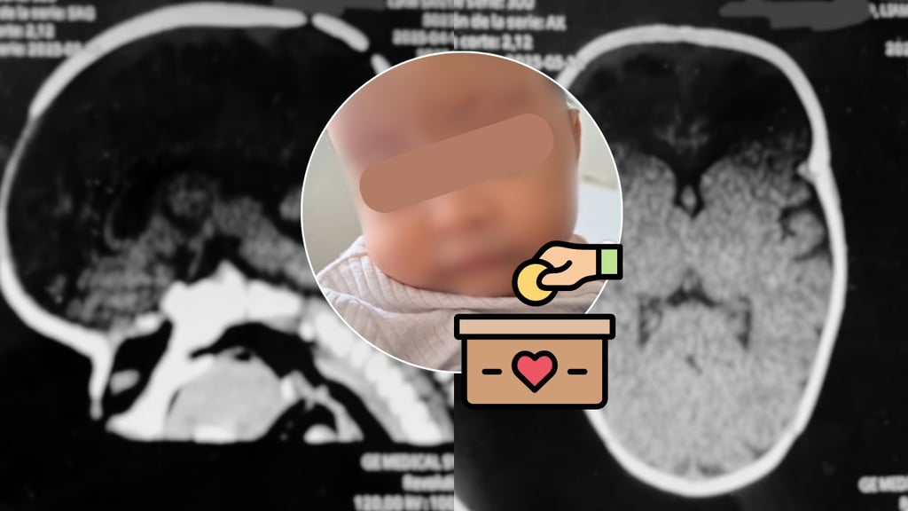 ¡Ayuda a Santi! Necesita reunir 150 mil pesos para costear una cirugía en su cabecita