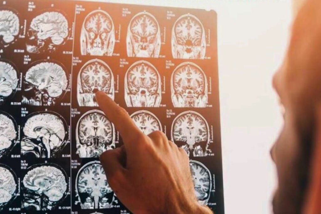 'Mi cuerpo dejó de obedecerme': Paola Hidalgo y su lucha contra la esclerosis múltiple