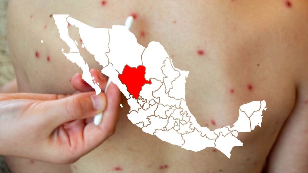 Durango, cuarto estado con más casos de sarampión en el país; no se han registrado decesos