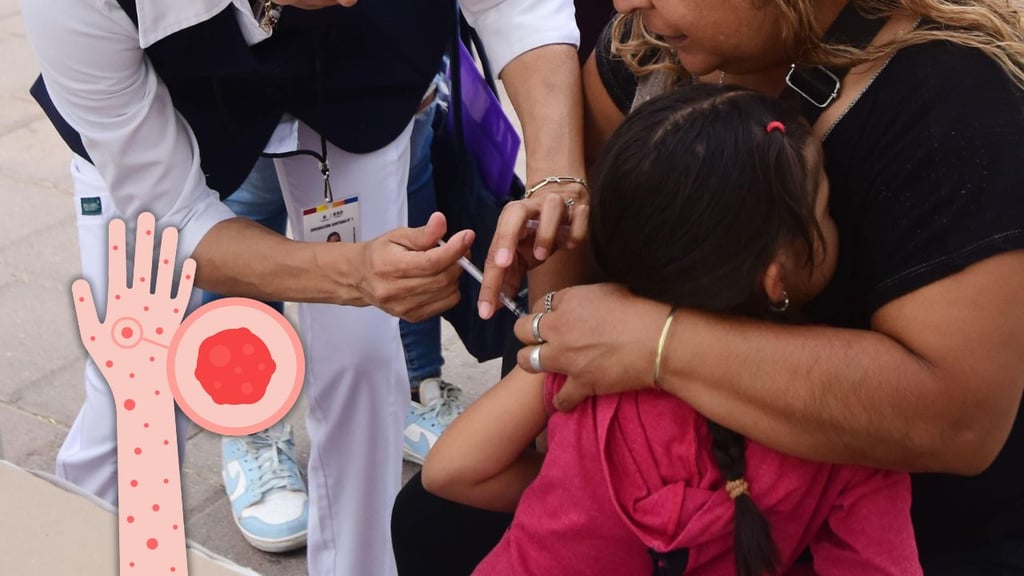 Durango suma 21 casos de sarampión; la mayoría son menores de edad