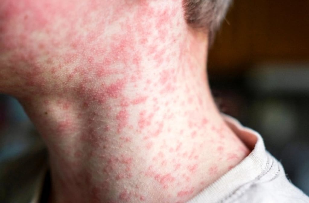 Reporte. Un total de 40 casos de sarampión ha detectado hasta la fecha la Secretaría de Salud en Durango. 