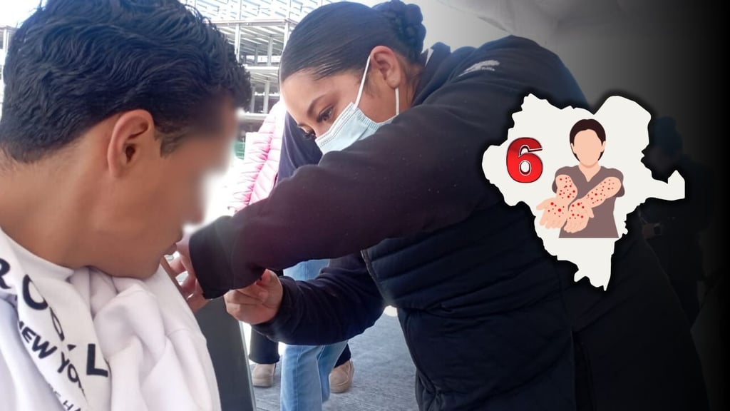 Confirman tres casos de sarampión en Mezquital; suman 6 positivos en Durango este 2026
