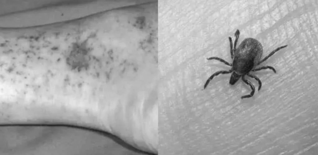 Rickettsia. La presencia de garrapatas es lo que provoca la Rickettsia; se recomienda tener limpio el lugar donde están las mascotas.