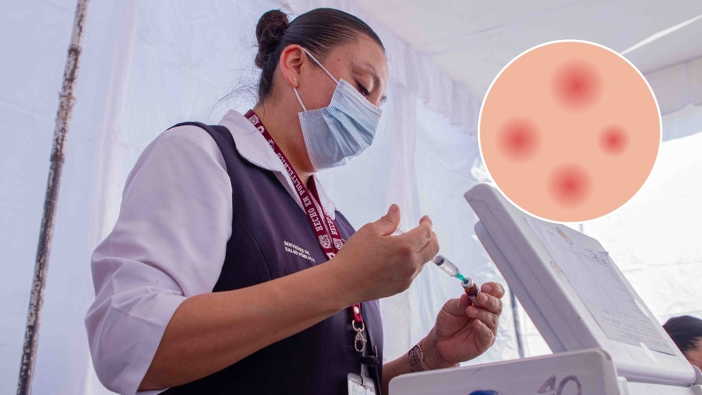 Confirman 6 nuevos casos de sarampión en Durango en las últimas 24 horas