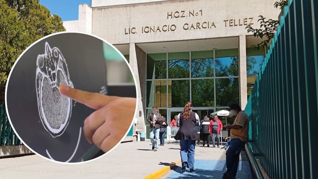 Código Cerebro, el protocolo del IMSS para atender urgencias neurológicas en Durango, ¿de qué trata?