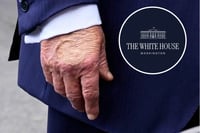 Diagnostican a Trump con insuficiencia venosa crónica tras hinchazón de piernas
