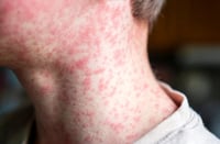 Mapimí confirma 18 casos positivos y una muerte por sarampión