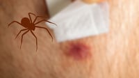 Araña violinista: ¿cómo identificarla y qué hacer si sufres una picadura?
