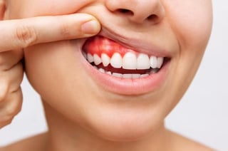 Previene el sarro y la gingivitis en tus dientes con esta hierba