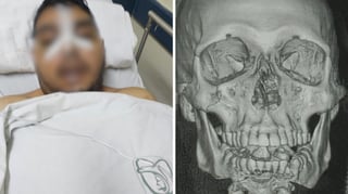 Paciente fue golpeado al interior del Hospital Psiquiátrico de Durango; tiene fracturas en rostro