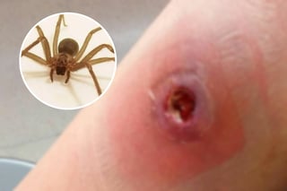 Araña violinista: así se ve la picadura de este arácnido