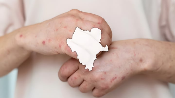 Sarampión en Durango: asciende a 19 la cifra de casos postivos en el estado