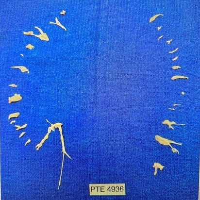 Estos son los coágulos que tenía Grecia en sus pulmones , lograron sacarle todos estos , quedaron unos muy muy pequeños