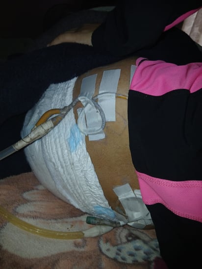 Kenia iene una sonda en cada riñón por lo que tienen que hacerle curación diariamente y  ponerle parches para que no se infecte. 