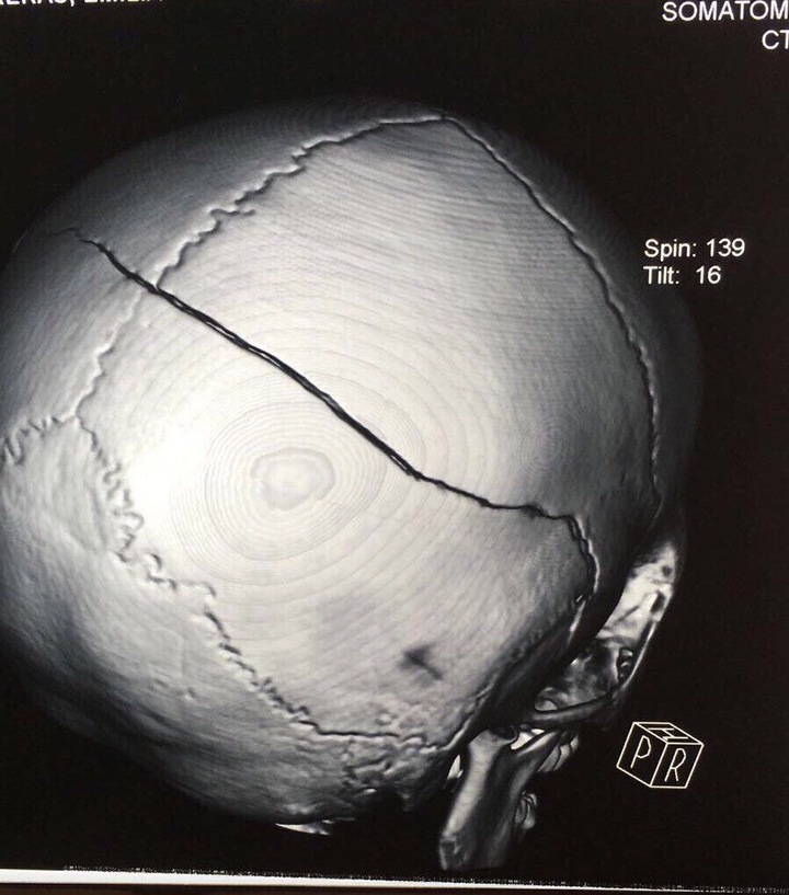 Evoluciona bien niña con fractura craneal