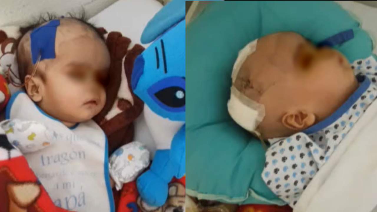 Piden Ayuda Para Bebé Con Hidrocefalia Se Encuentra En El Materno Infantil 0971